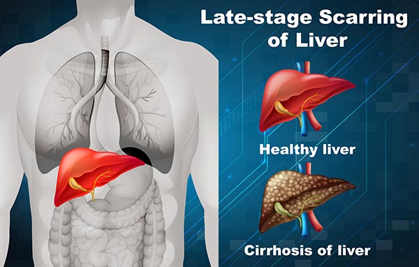 Scarring of the liver and cirrhosis